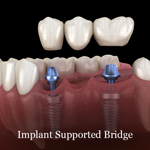 dental-imlpants-in-mexico-bridge - Dental Laser Nogales
