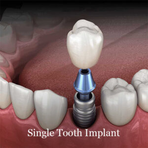 Dental Implants - Dental Laser Nogales