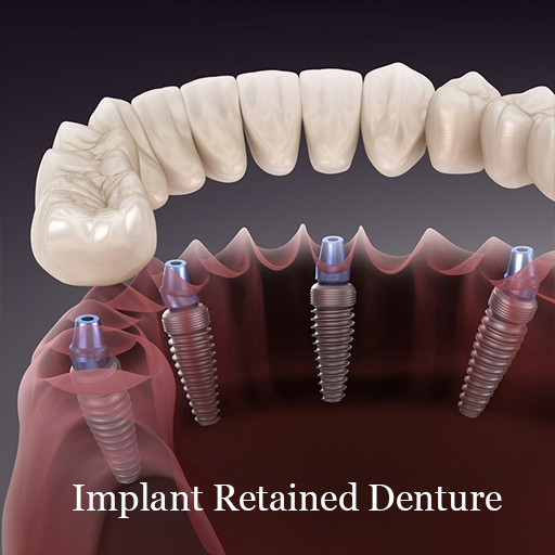 dental-implants-in-mexico - Dental Laser Nogales