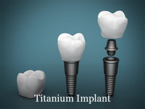 titanium-implants-in-mexico - Dental Laser Nogales