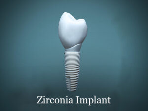 zirconia-dental-implants-in-mexico - Dental Laser Nogales
