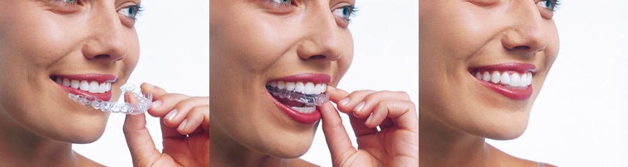 invisalign-prices - Dental Laser Nogales
