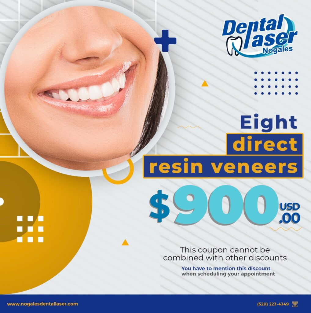 resin-veneers-deals - Dental Laser Nogales